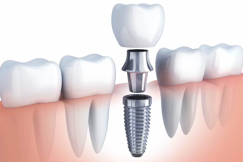 Implants Dentist in  Huntington Beach