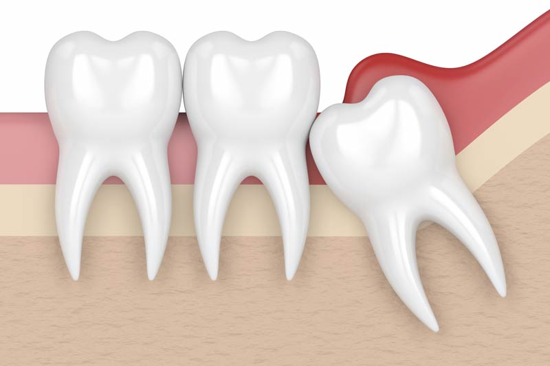 Wisdom Tooth Removal in  Huntington Beach
